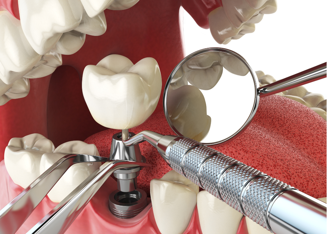 Dental Implants